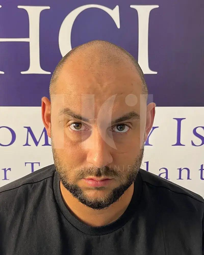 Haartransplantatie resultaat voor behandeling - 4