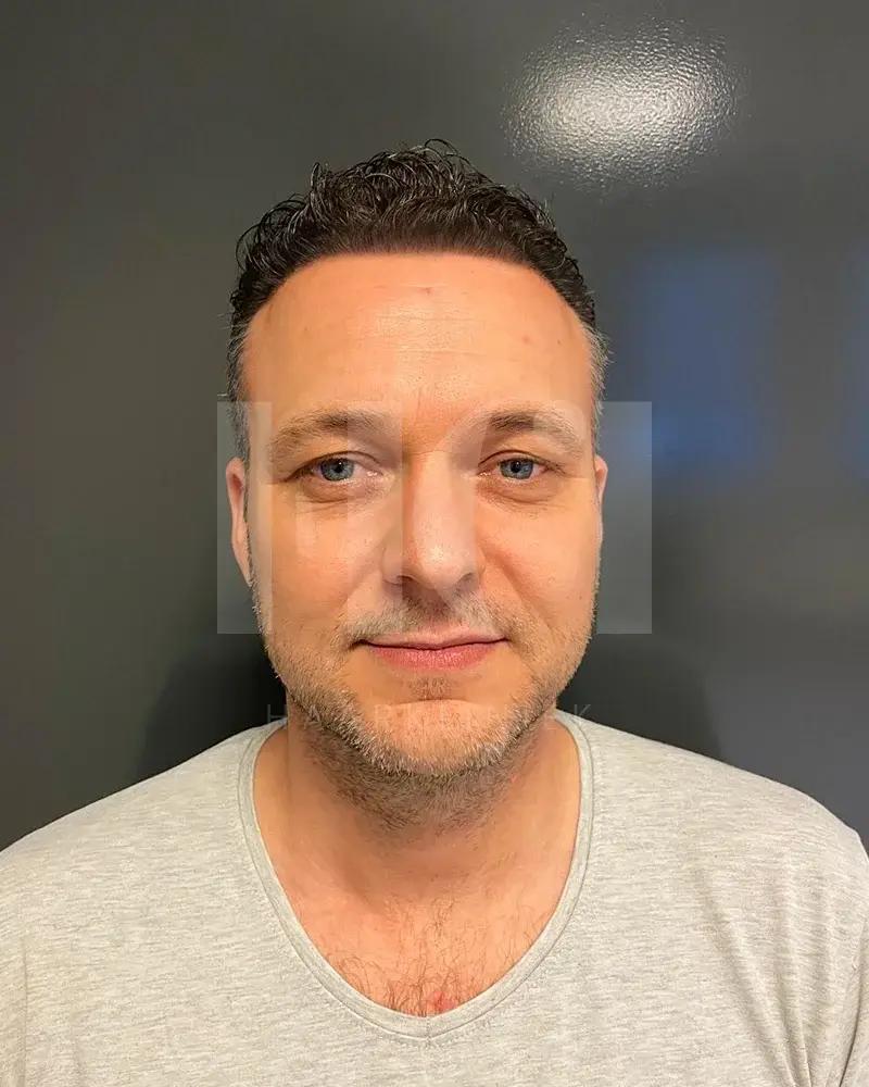 Haartransplantatie resultaat na behandeling - 5